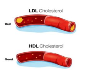 LDL Cholesterol (Bad Cholesterol) and HDL Cholesterol (Good Cholesterol)